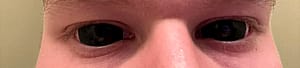 Blurry Contacts'